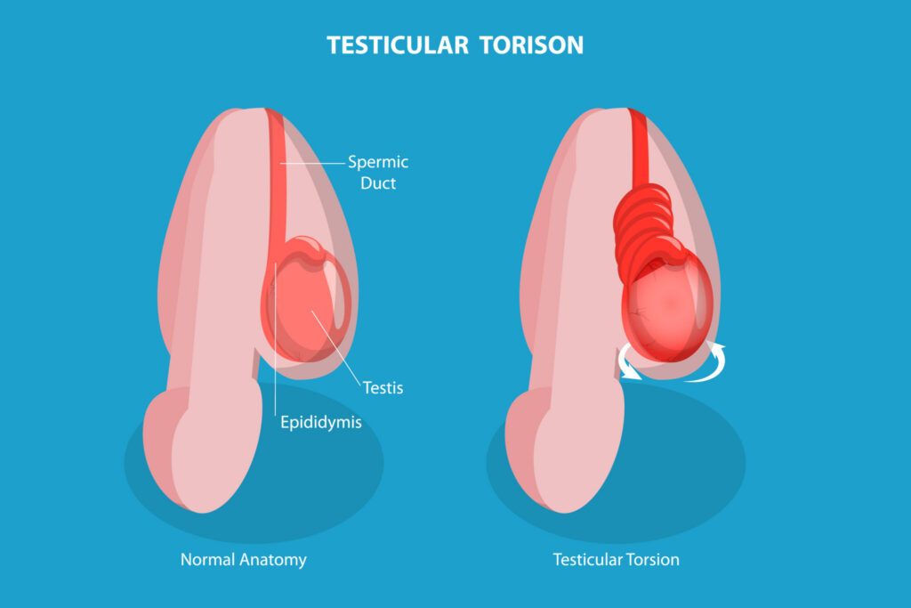 The image shows an educational health infographic about testicular torsion, with two side-by-side anatomical illustrations of the testicles.
On the left side is an illustration labelled “Normal Anatomy” showing the healthy structure with three labelled parts: the spermic duct (at the top), the testis (in the middle), and the epididymis (at the bottom).
On the right side is an illustration labelled “Testicular Torsion” showing the affected condition, where the blood vessels and spermic duct have become twisted. This illustration includes white arrows indicating the twisting motion that occurs during torsion.
