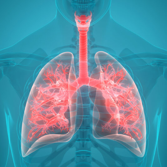 Illustration of the lungs affected by pneumonia