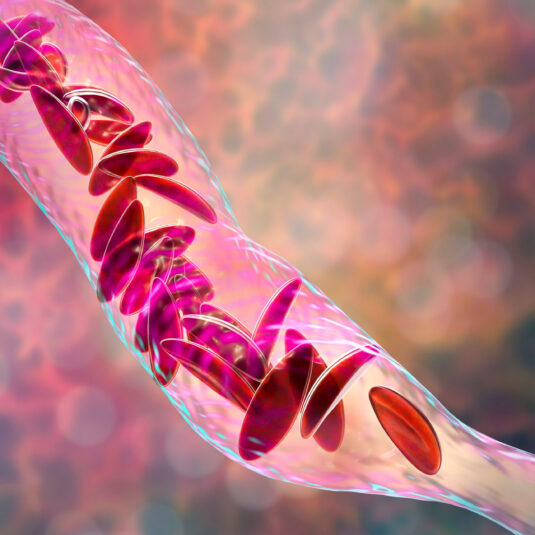 Illustration of sickle cell disease affecting red blood cells in the bloodstream.