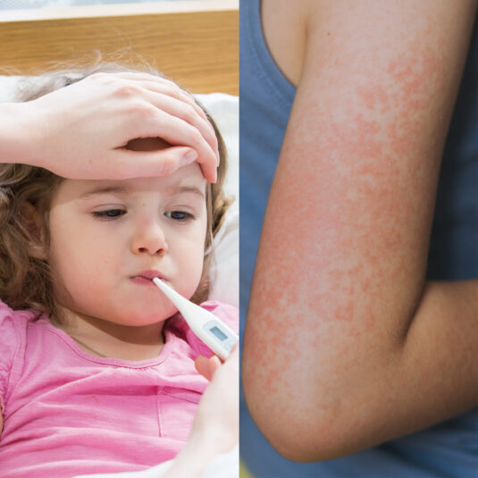 Child with a thermometer and a close-up of a red skin rash, suggesting fever accompanied by a rash.